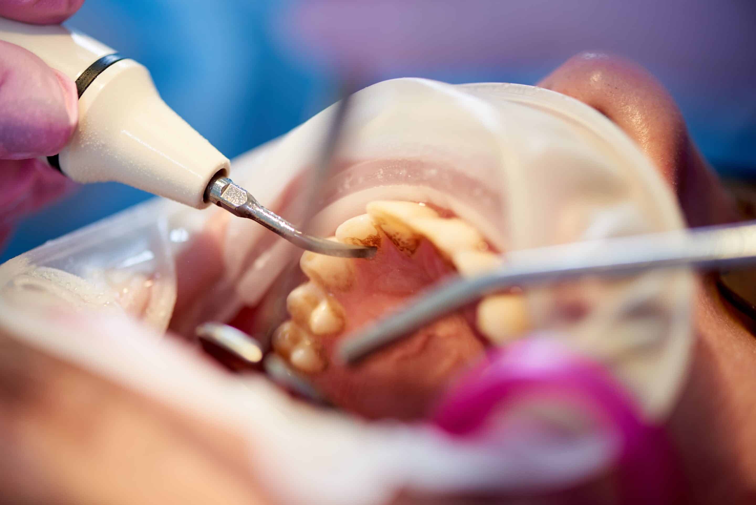 Ursachen für eine Wurzelentzündung Warum wird eine Wurzelbehandlung nötig